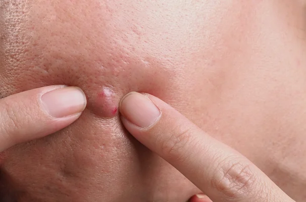 สาเหตุของฝี