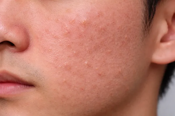 สิวอุดตันไม่มีหัว (Microcomedone)