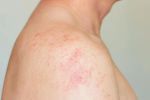 ภาพคนเป็นเชื้อราผิวหนัง ที่มีลักษณะผื่นคันแดง