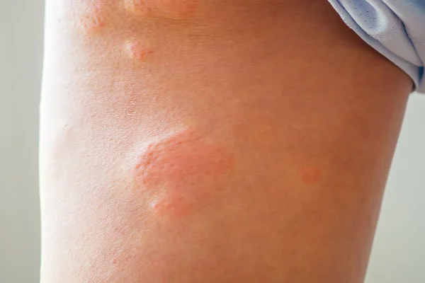 ชายหนุ่มเอเชียมีผื่นแพ้ที่ขาจากอาการคันผิวหนังแห้งกลากผิวหนังอักเสบ