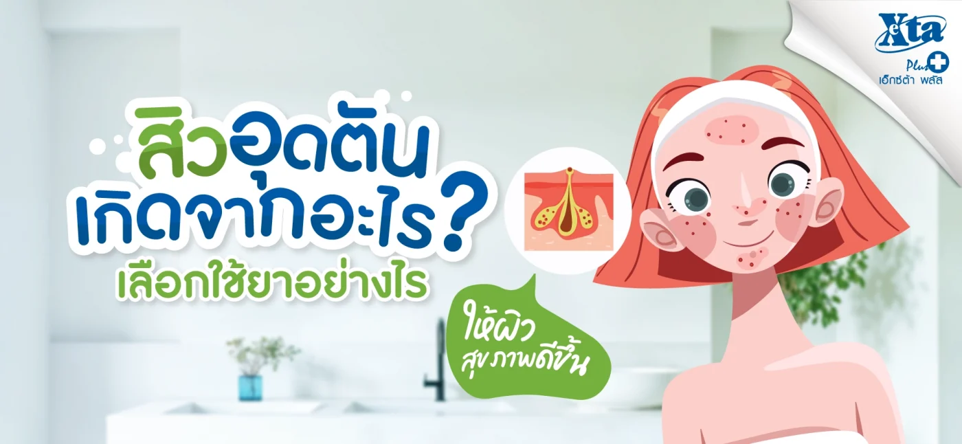 สิวอุดตันเกิดจากอะไร เลือกใช้ยารักษาอย่างไร ให้ผิวดีขึ้น คำแนะนำจากร้านยา เอ็กซ์ต้า พลัส