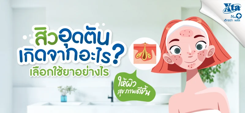 สิวอุดตันเกิดจากอะไร เลือกใช้ยารักษาอย่างไร ให้ผิวดีขึ้น คำแนะนำจากร้านยา เอ็กซ์ต้า พลัส