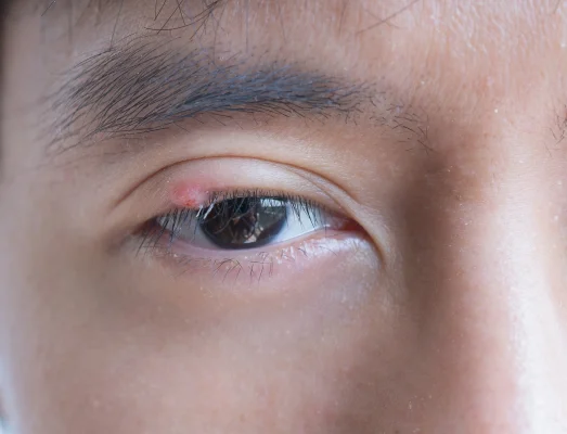 ตากุ้งยิงที่เกิดขึ้นบนเปลือกตาขวาของผู้ชายชาวเอเชีย